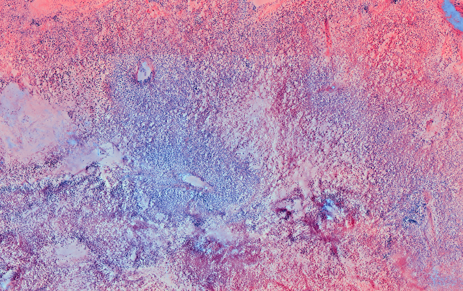 Canine-Periosteal-chondroblastic-osteosarcoma-distal-femur